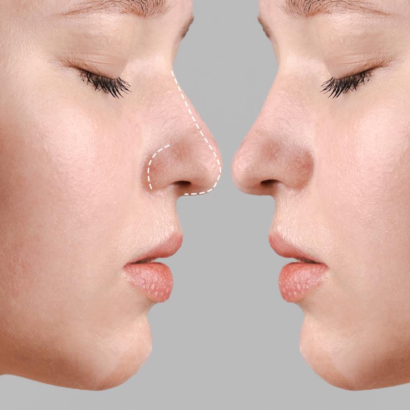 Service Unveil Your Ideal Nose with Rhinoplasty Image