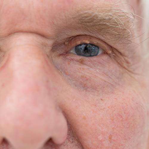 Service Lift Your Gaze: Expert Care for Ptosis Image