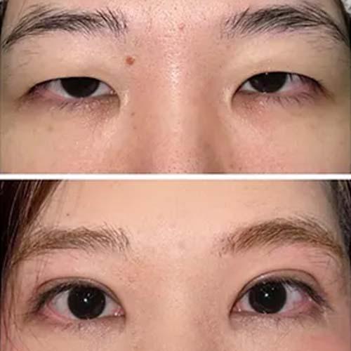 Service Enhance Your Natural Beauty with Double Eyelid Surgery Image