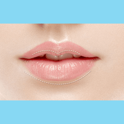 Service Chestnut-shaped lip and Lip Reduction Surgery Image