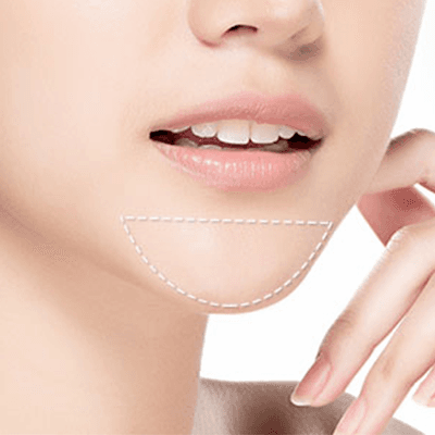 Service Chin Augmentation Image