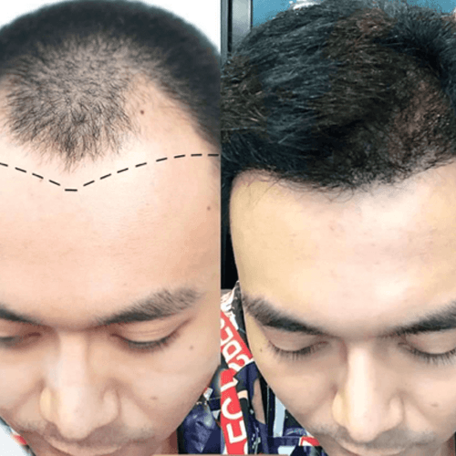 Service HAIR TRANSPLANT Image