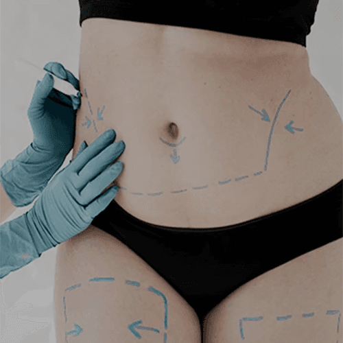 Service Fat Dissolving Injection with FatAway: Sculpt Your Body Safely Image