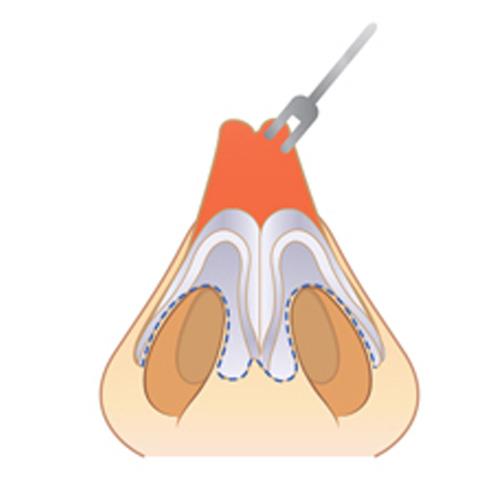 Service Open rhinoplasty Image