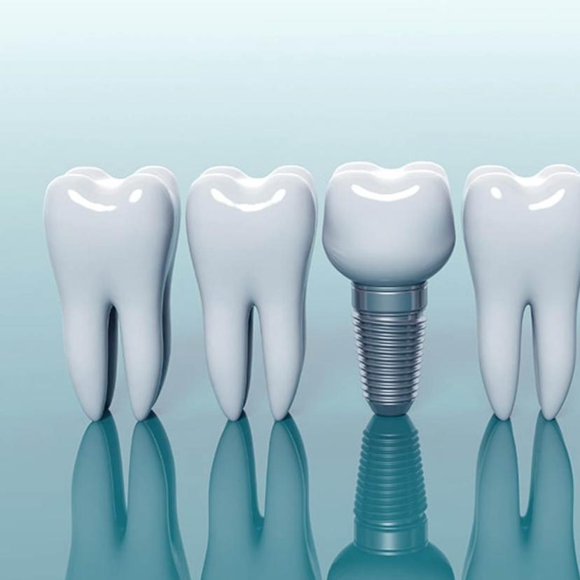 Service Dental Implant Image