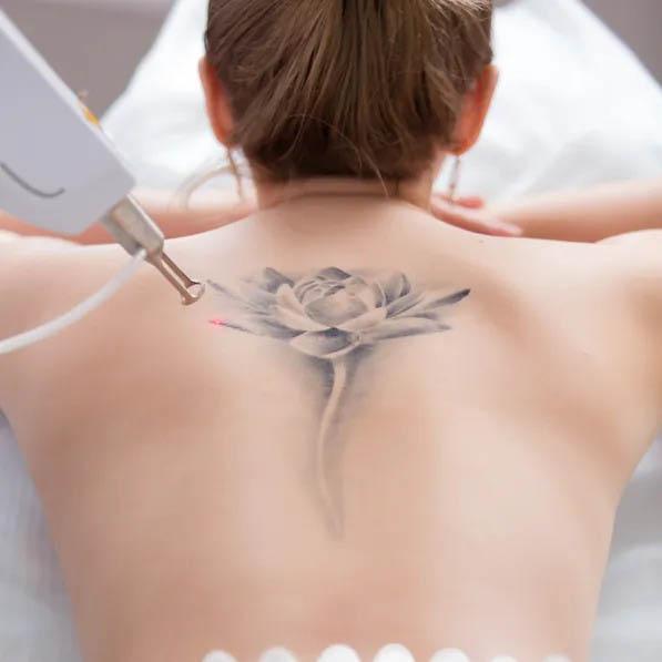 Service Tattoo Removal Image