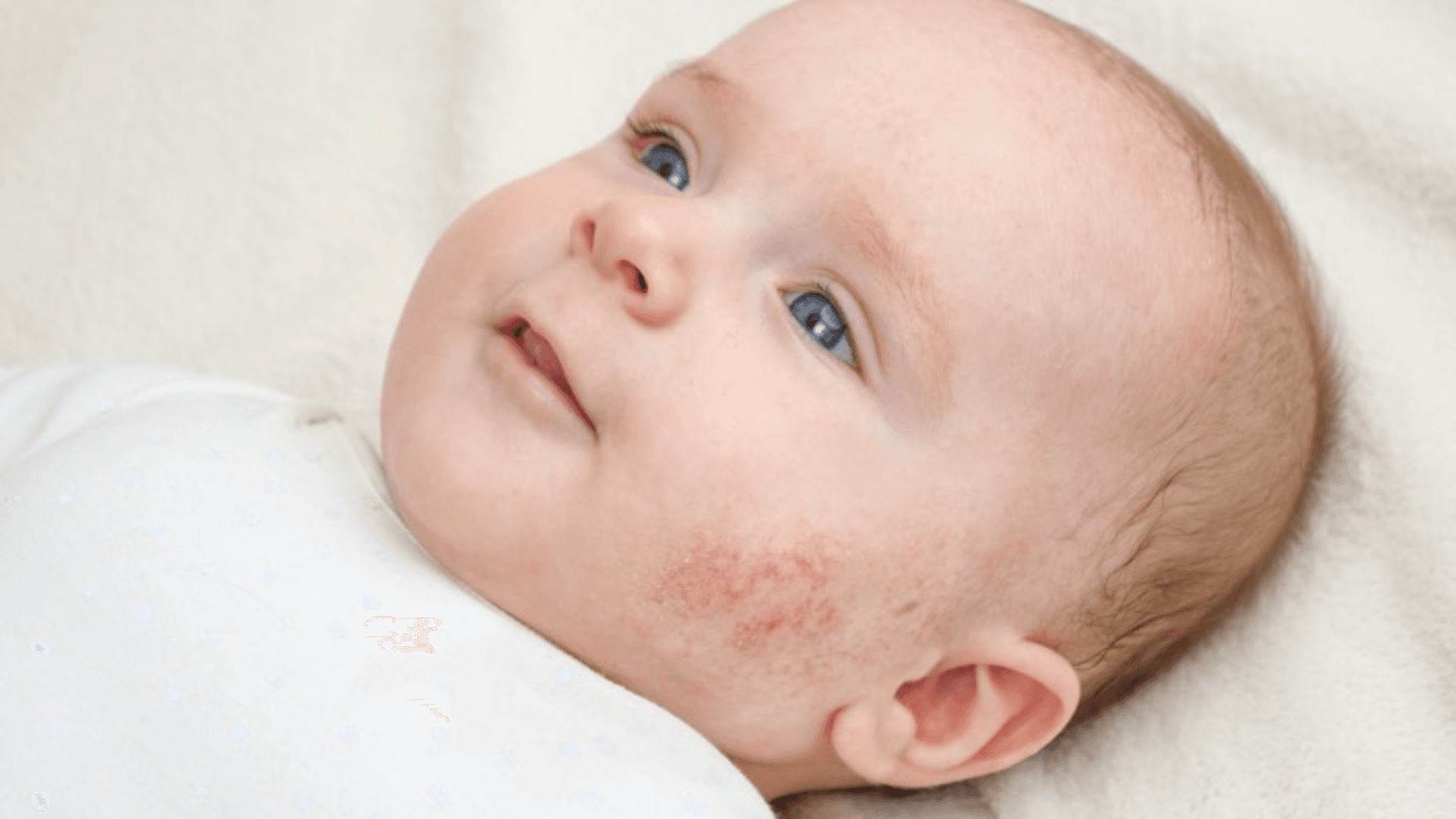 Blog: Understanding Baby Acne: A Guide for Parents
