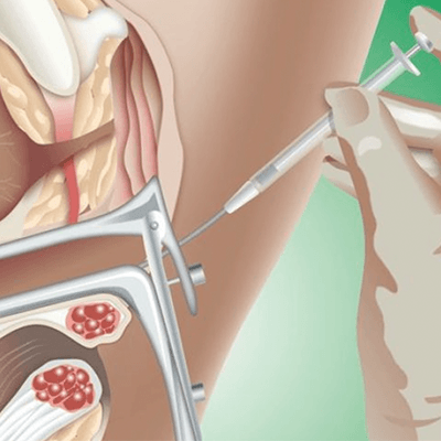 Service Intra Cytoplasmic Sperm Injection – ICSI Image