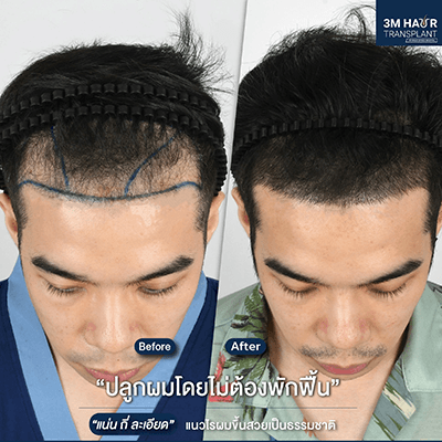 Service HAIR TRANSPLANT Image