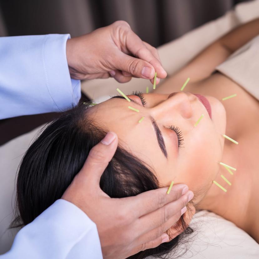 Service Discover the Natural Beauty of Acupuncture for Acne Treatment Image