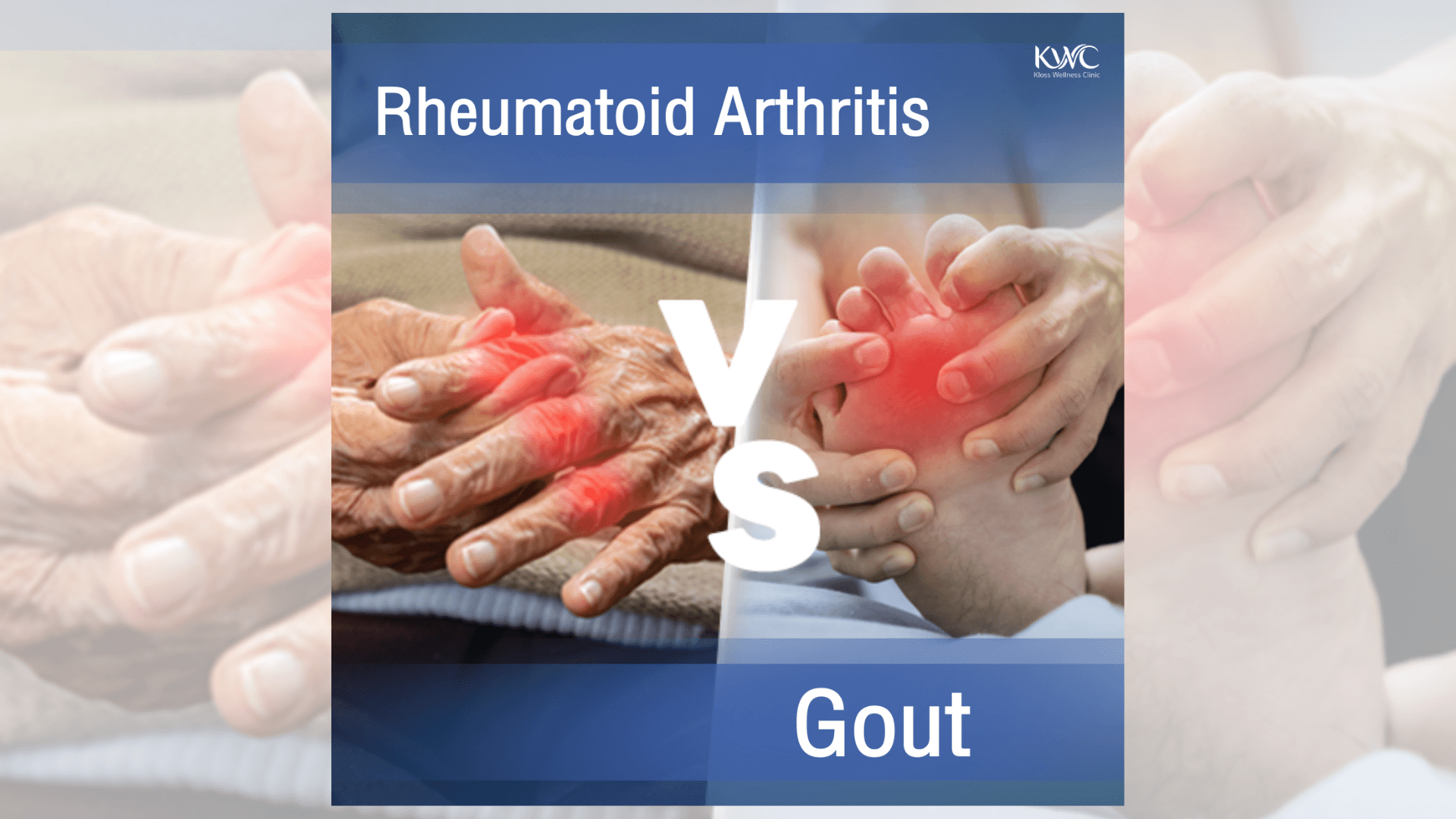 Blog: Gout and Rheumatoid Arthritis Did you know they’re different?